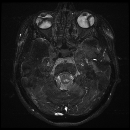 Acoustic neuroma (Radiopaedia 34049-35283 Axial 84).png