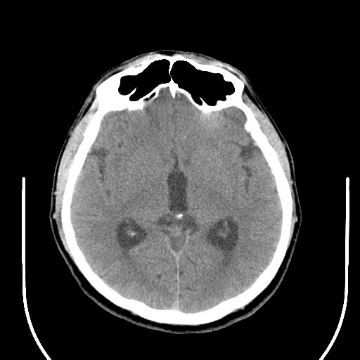 File:Acoustic schwannoma (Radiopaedia 29488-29982 AXIAL THICK non-contrast 24).jpg