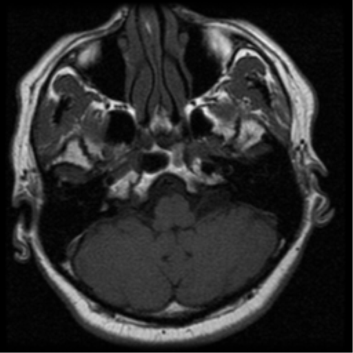 File:Acoustic schwannoma (Radiopaedia 33045-34060 Axial T1 5).png