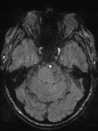 Acoustic schwannoma (Radiopaedia 55729-62281 Axial SWI 16).png