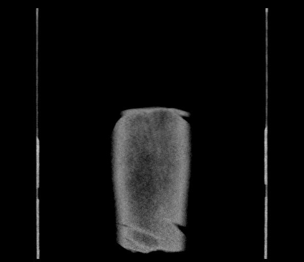 Acromioclavicular joint cyst (Radiopaedia 58455-65610 Coronal C+ arterial phase 152).jpg
