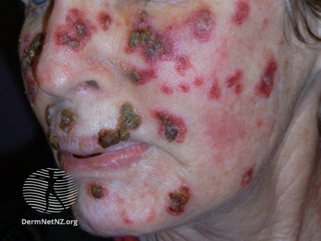 File:Actinic Keratoses treated with imiquimod (DermNet NZ lesions-ak-imiquimod-3723).jpg