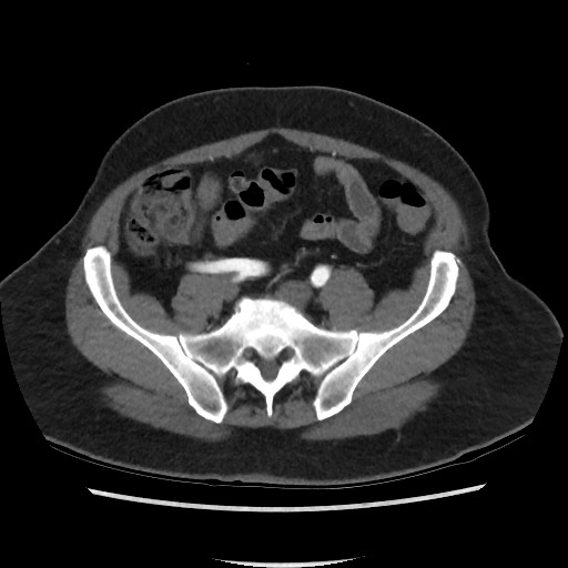 File:Active colonic bleed on CT (Radiopaedia 49765-55025 Axial C+ arterial phase 60).jpg