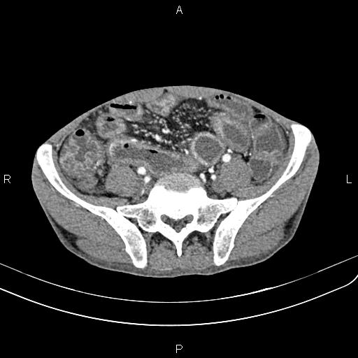 Active crohn disease (Radiopaedia 87133-103397 Axial C+ arterial phase 75).jpg