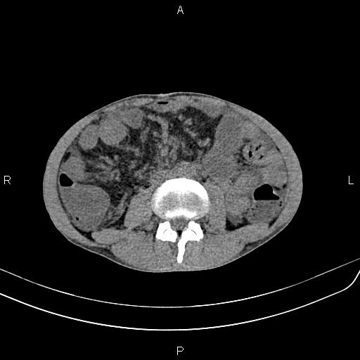 Active crohn disease (Radiopaedia 87133-103397 Axial non-contrast 55).jpg