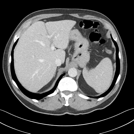 File:Active diverticular hemorrhage (Radiopaedia 39415-41725 Axial C+ portal venous phase 12).png