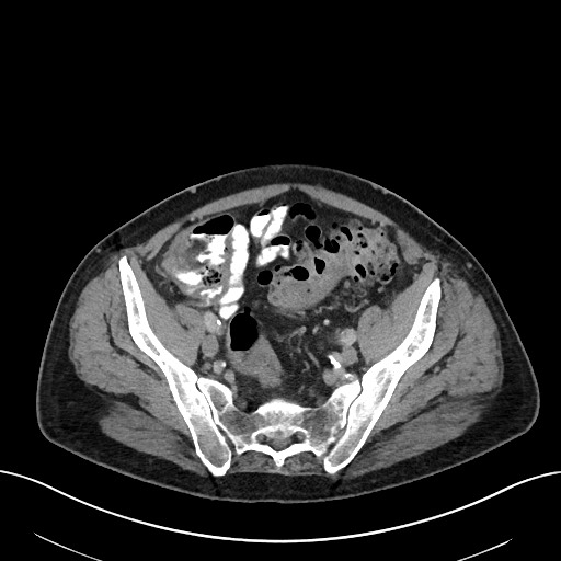 Active lower gastrointestinal bleeding - diverticular (Radiopaedia 61203-69106 Axial C+ portal venous phase 99).jpg