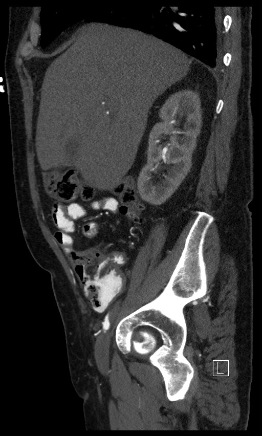 Active lower gastrointestinal bleeding - diverticular (Radiopaedia 61203-69106 Sagittal C+ arterial phase 114).jpg