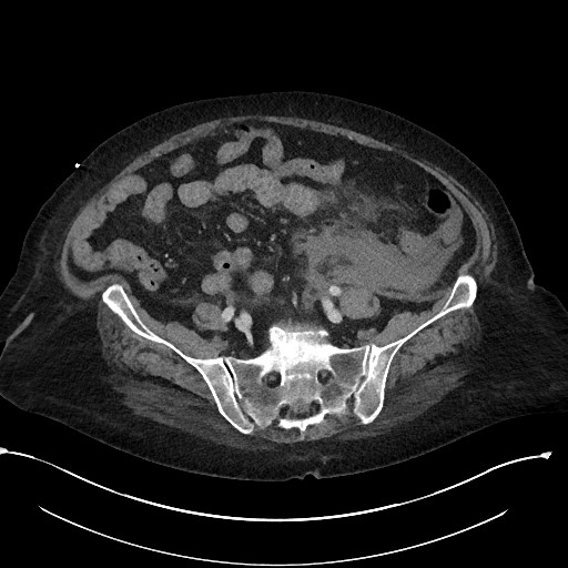 File:Active renal extravasation with large subcapsular and retroperitoneal hemorrhage (Radiopaedia 60975-68796 Axial 258).jpg