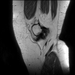 Acute-on-chronic transient lateral patellar dislocation with trochlear dysplasia (Radiopaedia 84099-99349 Sagittal PD 25).jpg