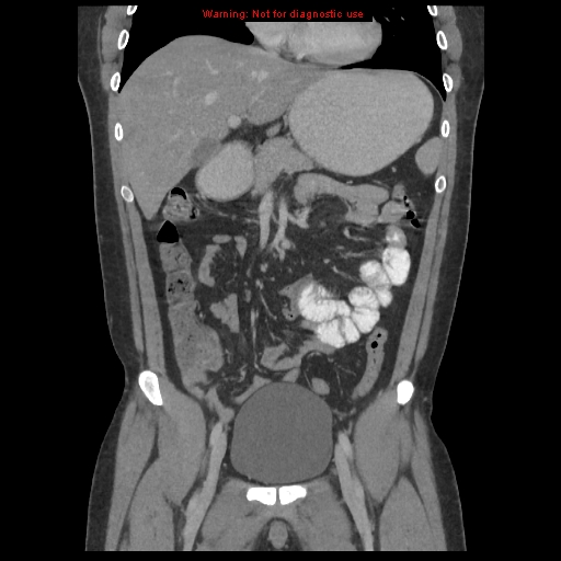 File:Acute appendicitis (Radiopaedia 10498-10973 F 9).jpg