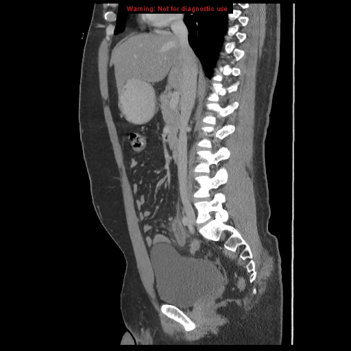 File:Acute appendicitis (Radiopaedia 10498-10973 Sagittal C+ portal venous phase 24).jpg