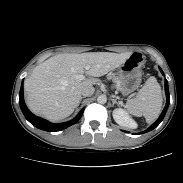 Acute appendicitis (Radiopaedia 27049-27227 Axial C+ portal venous phase 16).jpg