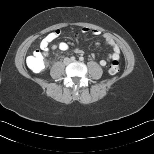 File:Acute appendicitis (Radiopaedia 30297-30934 Axial C+ portal venous phase 50).jpg