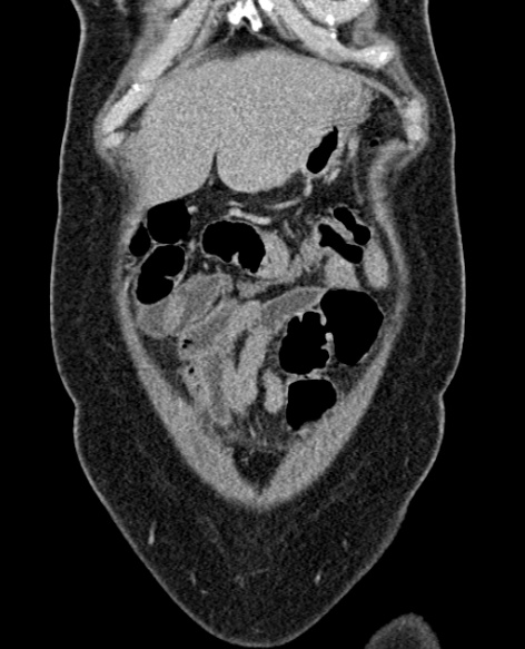 File:Acute appendicitis (Radiopaedia 48792-53822 Coronal C+ portal venous phase 51).jpg