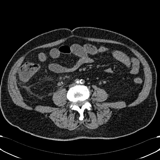 Acute appendicitis (Radiopaedia 58627-65818 Axial non-contrast 53).jpg