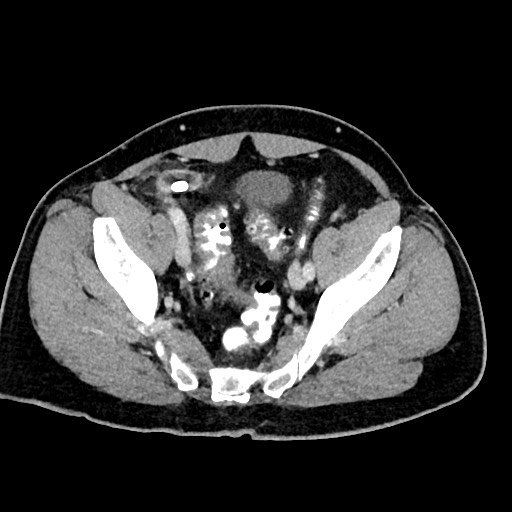 Acute appendicitis (Radiopaedia 77016-88960 Axial C+ portal venous phase 119).jpg