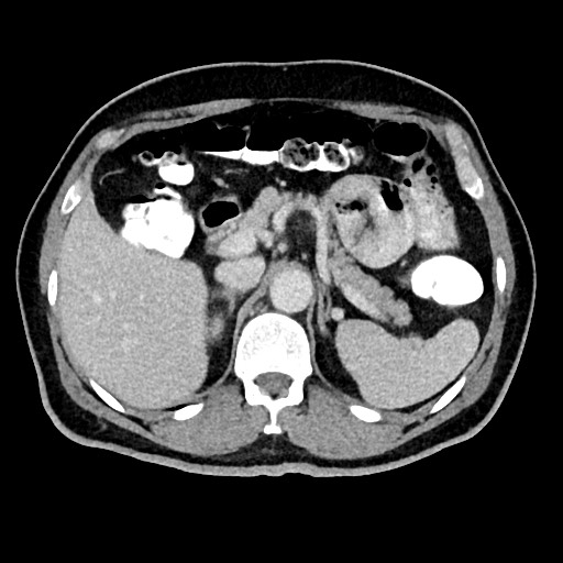 Acute appendicitis (Radiopaedia 77016-88960 Axial C+ portal venous phase 43).jpg
