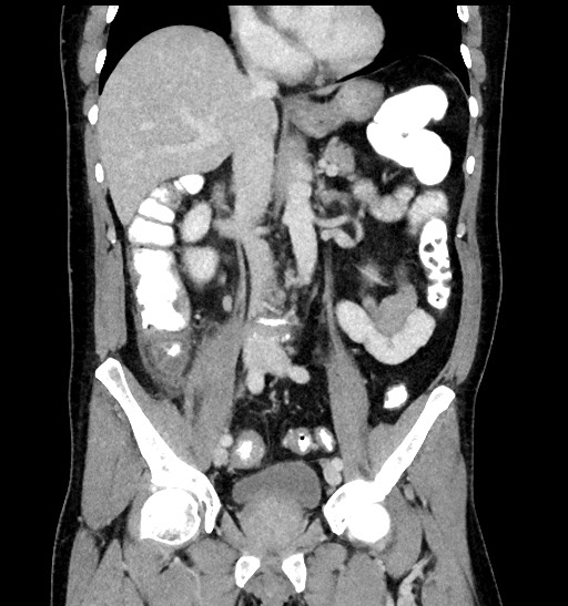 Acute appendicitis (Radiopaedia 77016-88960 Coronal C+ portal venous phase 52).jpg
