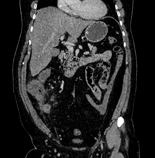 Acute appendicitis (Radiopaedia 79950-93224 Coronal C+ portal venous phase 37).jpg