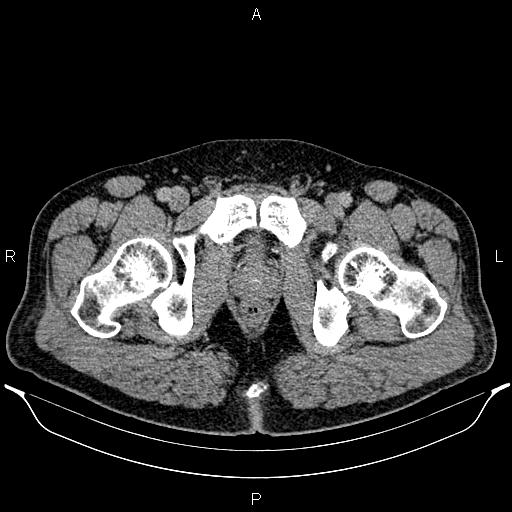Acute appendicitis (Radiopaedia 84780-100240 Axial C+ portal venous phase 111).jpg