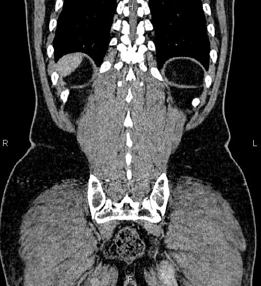 Acute appendicitis (Radiopaedia 84780-100240 Coronal C+ portal venous phase 72).jpg