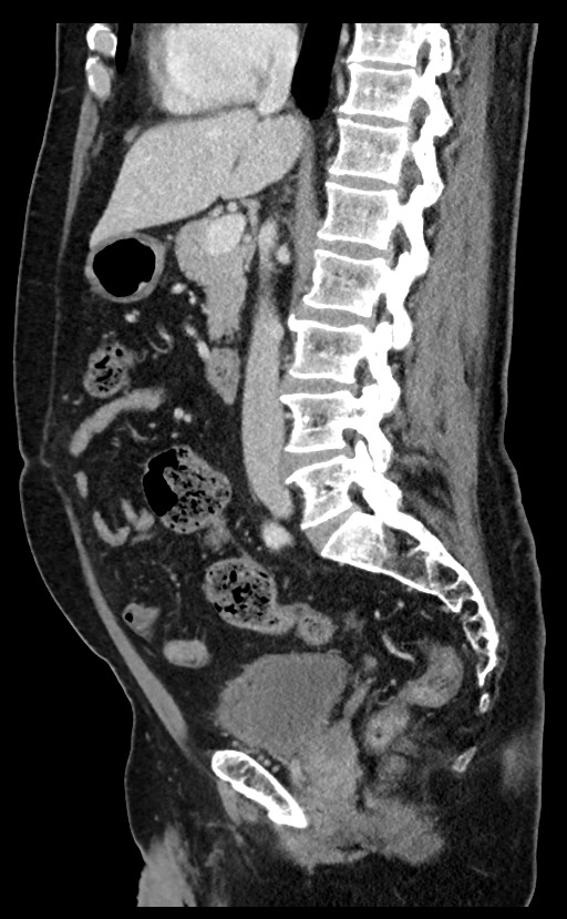Acute appendicitis - large appendicoliths (Radiopaedia 61805-69820 Sagittal C+ portal venous phase 62).jpg
