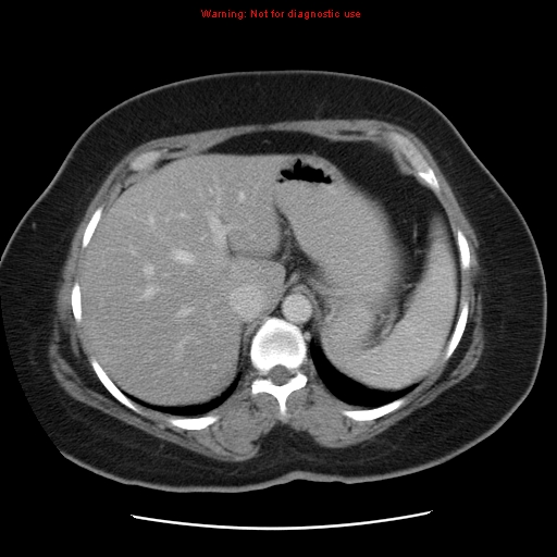 Acute appendicitis complicated by ovarian vein thrombophlebitis (Radiopaedia 16172-15851 Axial C+ portal venous phase 22).jpg