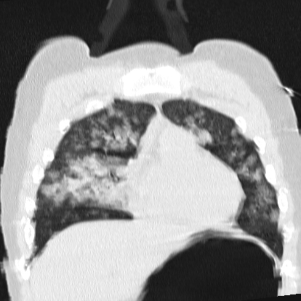 Acute aspiration pneumonitis (Radiopaedia 33605-34703 Coronal lung window 28).jpg