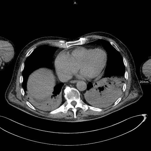 Acute aspiration pneumonitis (Radiopaedia 55642-62166 Axial liver window 46).jpg