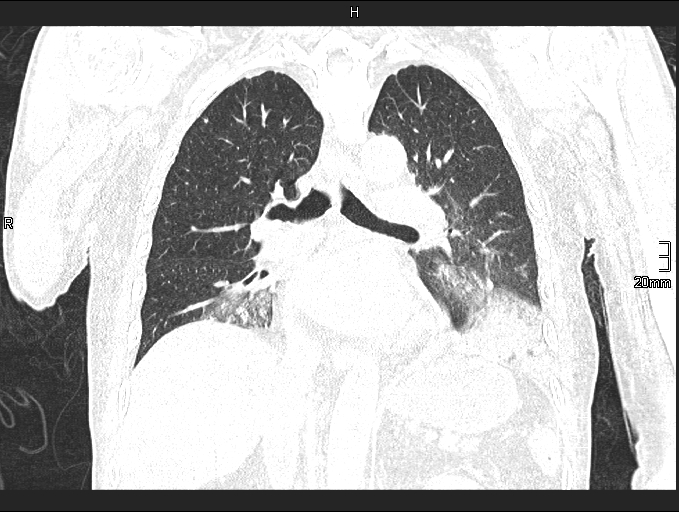 Acute aspiration pneumonitis (Radiopaedia 55642-62166 Coronal lung window 58).jpg