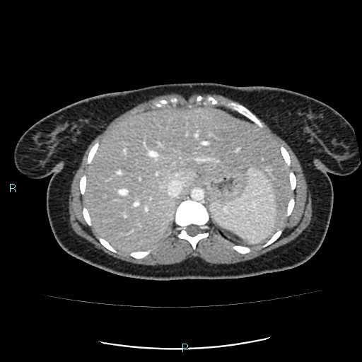 File:Acute bilateral pyelonephritis (Radiopaedia 37146-38881 Axial C+ portal venous phase 17).jpg