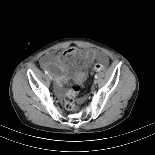 Acute bowel ischemia (Radiopaedia 87695-104114 Axial C+ portal venous phase 71).jpg