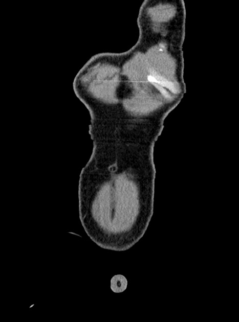 Acute bowel ischemia (Radiopaedia 87695-104114 Coronal C+ portal venous phase 63).jpg