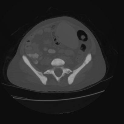 Acute calculous cholecystitis in patient with osteopetrosis (Radiopaedia 77871-90159 Axial bone window 35).jpg