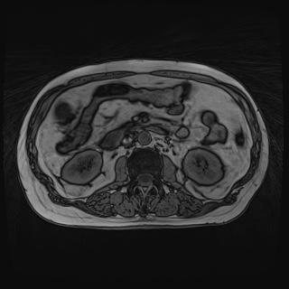 Acute cholecystitis (Radiopaedia 72392-82923 Axial T1 out-of-phase 71).jpg