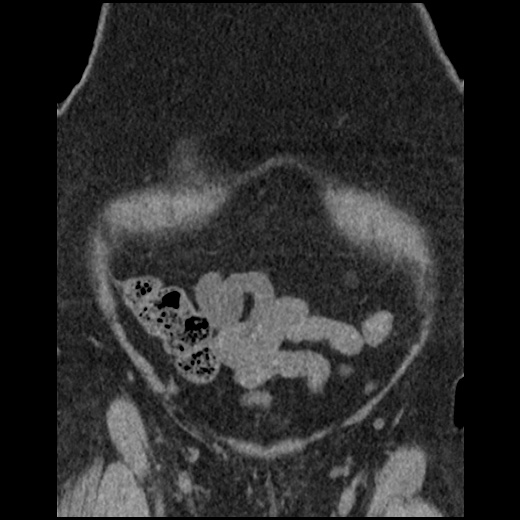 Acute cholecystitis and ureteric colic (Radiopaedia 42330-45444 Coronal prone 23).jpg