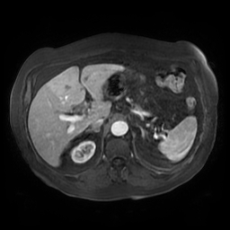 File:Acute cholecystitis complicated by pylephlebitis (Radiopaedia 65782-74915 Axial arterioportal phase T1 C+ fat sat 47).jpg