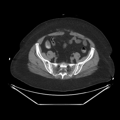 File:Acute cholecystitis with tensile fundus sign (Radiopaedia 71394-81723 Axial non-contrast 89).jpg