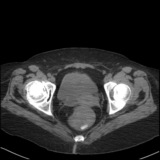 Acute colonic hemorrhage in ulcerative colitis (Radiopaedia 77415-89538 Axial non-contrast 127).jpg