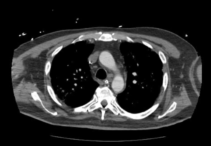 File:Acute cor pulmonale (ultrasound) (Radiopaedia 83508-98818 Axial C+ CTPA 22).jpg
