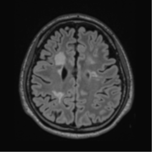 File:Acute disseminated encephalomyelitis (ADEM)- Anti-NMDA receptor encephalitis (Radiopaedia 54920-61201 Axial FLAIR 48).png
