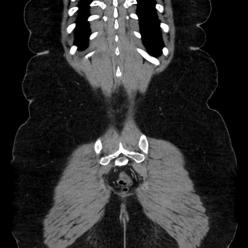 Acute diverticulitis - transverse colon (Radiopaedia 87063-103327 Coronal C+ portal venous phase 135).jpg