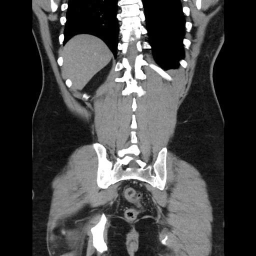 Acute diverticulitis with localized perforation (Radiopaedia 41296-44113 Coronal C+ portal venous phase 50).jpg