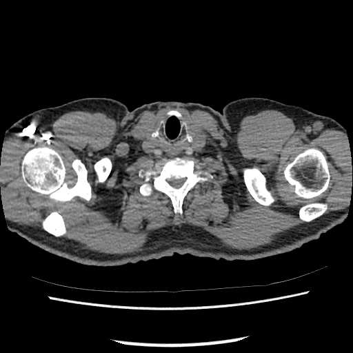 Acute epicardial fat necrosis (Radiopaedia 42327-45440 Axial C+ CTPA 5).jpg
