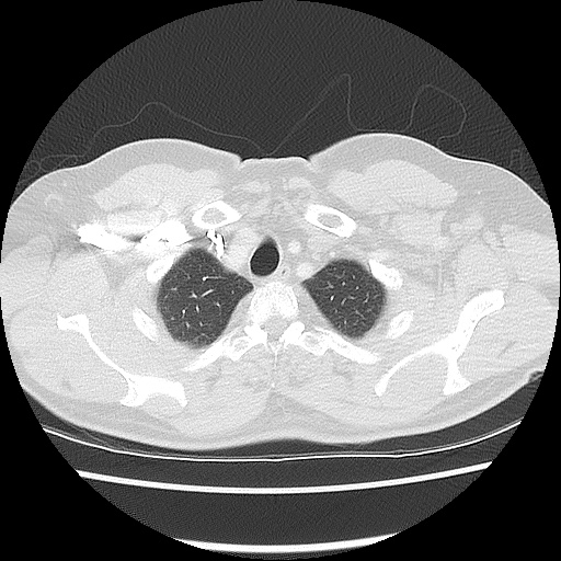 Acute epicardial fat necrosis (Radiopaedia 42327-45440 Axial lung window 12).jpg