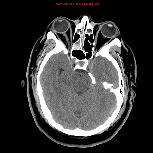File:Acute hemorrhagic leukoencephalitis (Radiopaedia 14076-13920 Axial non-contrast 16).jpg