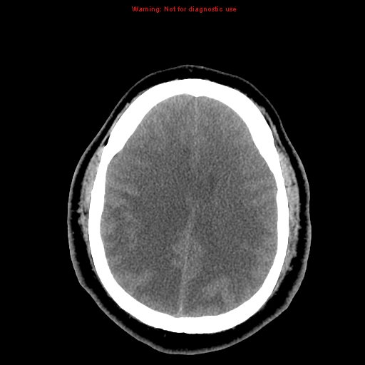 Acute hemorrhagic leukoencephalitis (Radiopaedia 14076-13920 Axial non-contrast 34).jpg