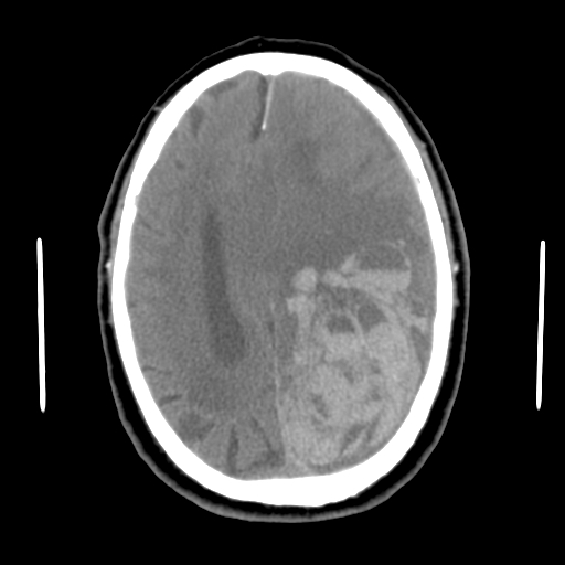 Acute hemorrhagic stroke (Radiopaedia 17507-17223 Axial non-contrast 34).jpg