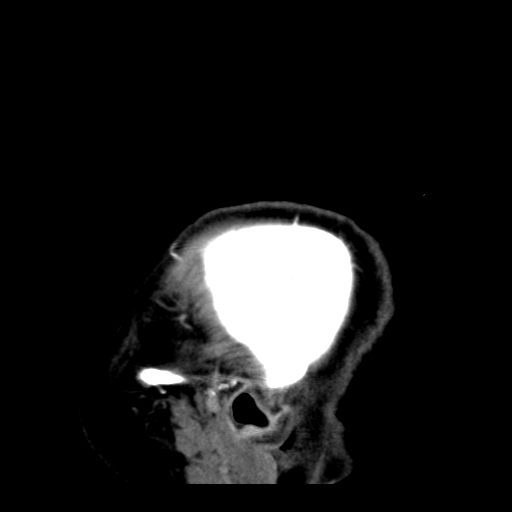File:Acute hemorrhagic stroke (Radiopaedia 17507-17223 Sagittal non-contrast 44).jpg